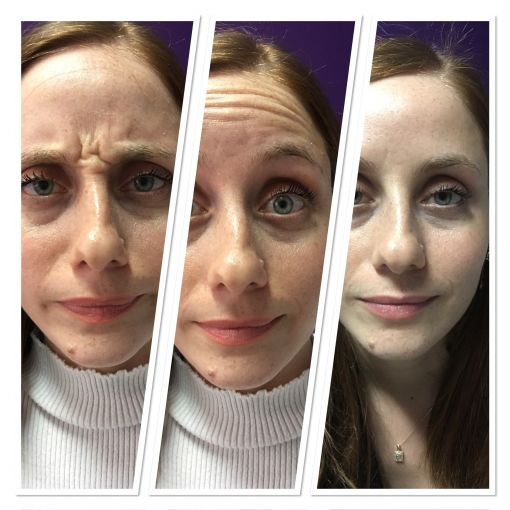 tüm Yüz Botox