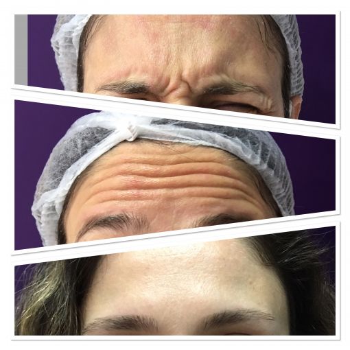 Yüz Botox