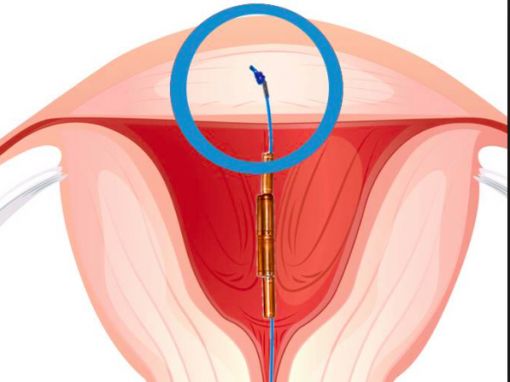  gynefix,boncuklu spiral