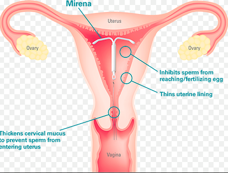  mirena,hormonluspiral